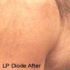 laser hair removal after