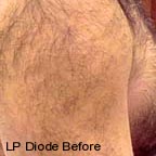 laser hair removal before