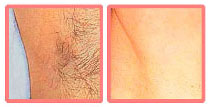 laser hair removal before and after pictures