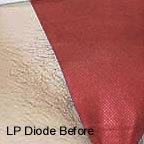 Laser Epilation bikini line before picture